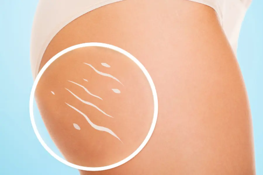 Rimedi inestetismi della cellulite: tutto quello che c’è da sapere