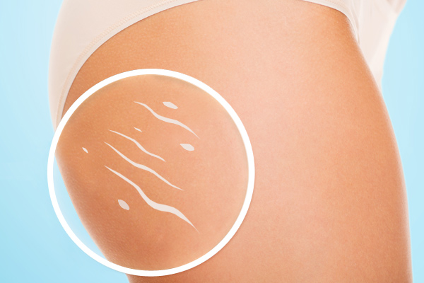 Rimedi inestetismi della cellulite: tutto quello che c’è da sapere