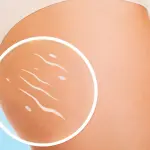Rimedi inestetismi della cellulite: tutto quello che c’è da sapere