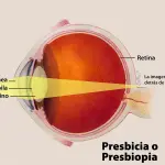 Intervento Presbiopia: in quali casi rivolgersi
